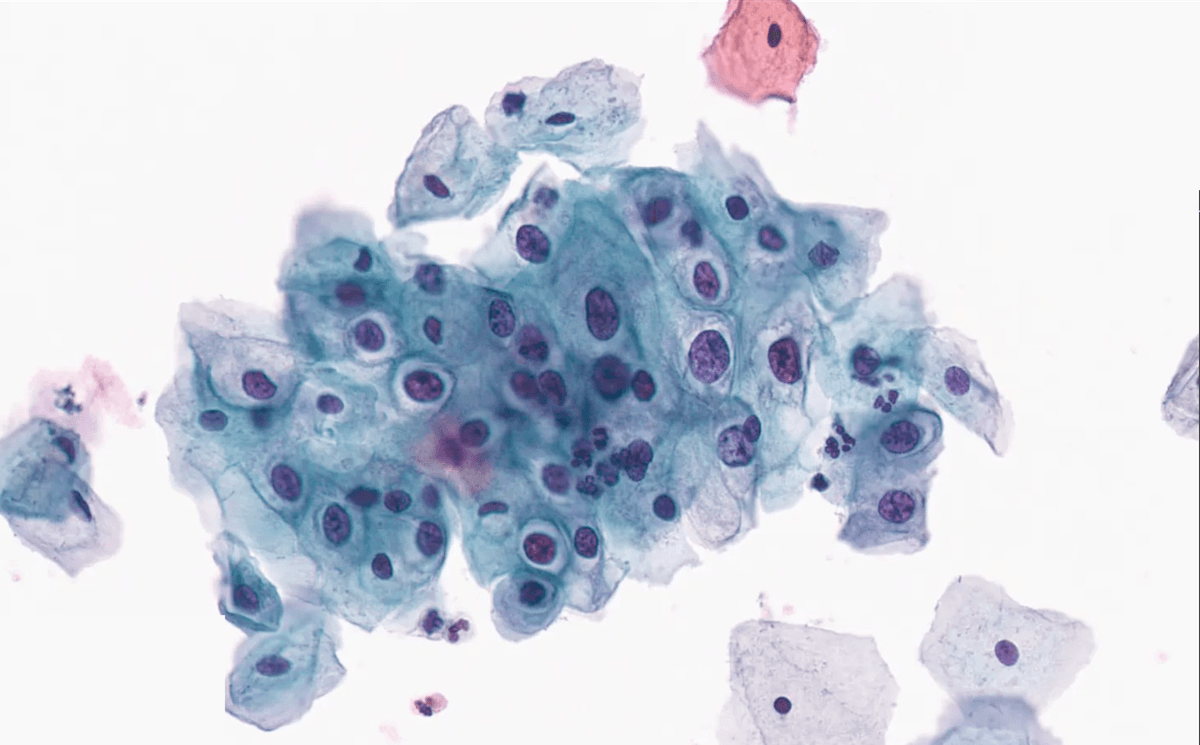Cervical Cancer microscopy