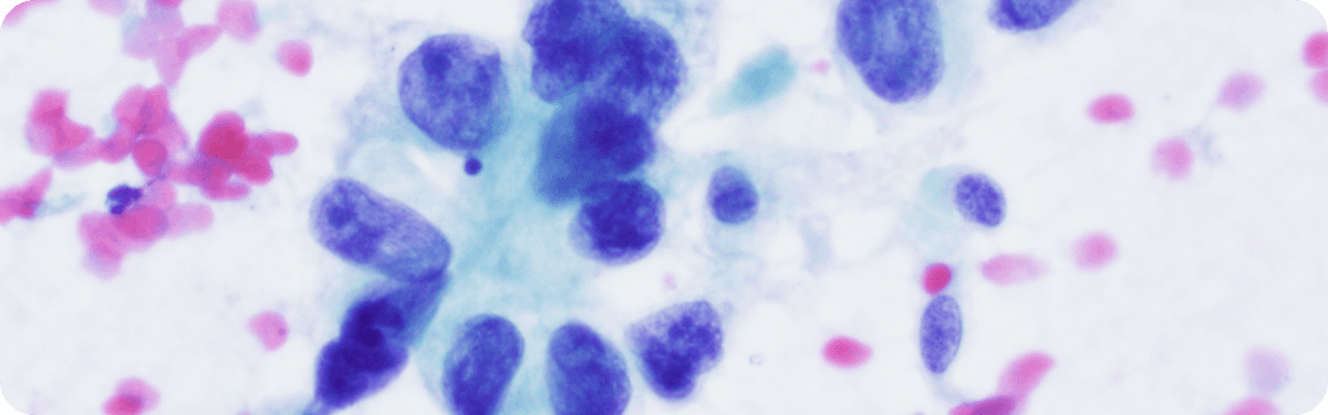 Lung Cancer microscopy