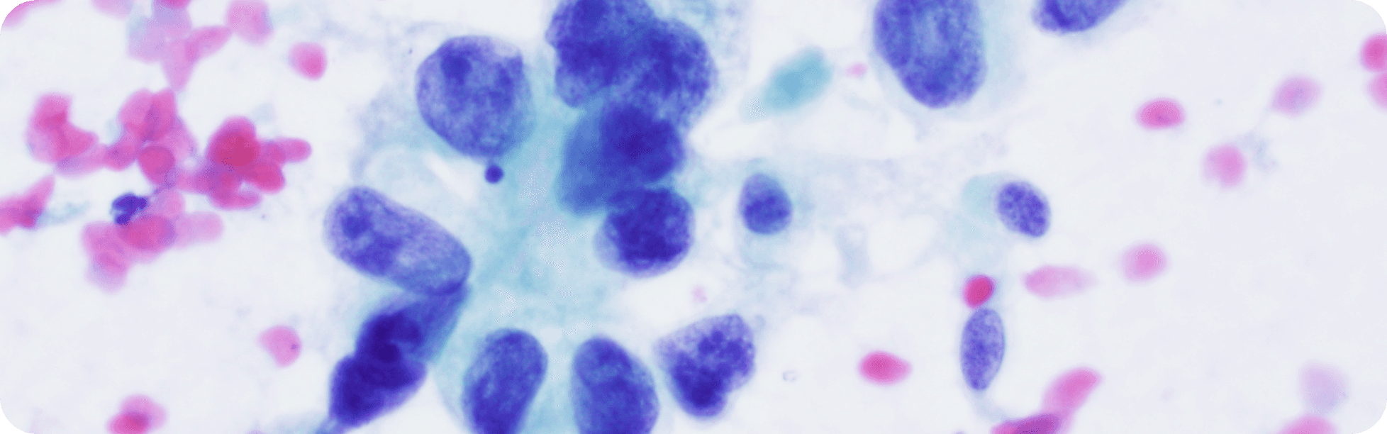 Pulmonary cytology microscopy