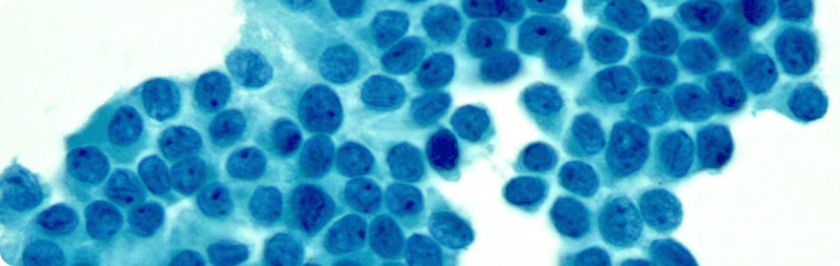 Thyroid Cancer microscopy